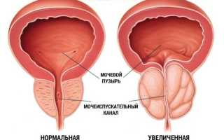 Простатит