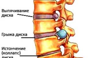 Остеохондроз