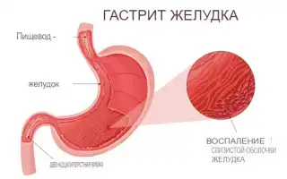 Гастрит