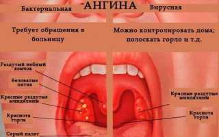 Ангина