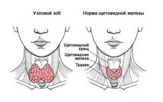Зоб