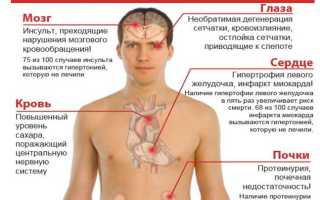 Гипертония