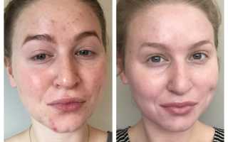 Лазерная чистка лица – отзывы с фото до и после проведения процедур