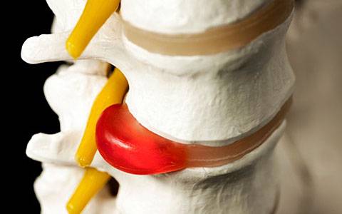 грыжа диска