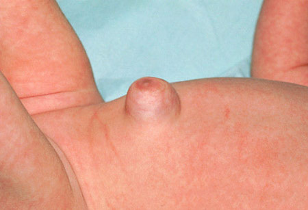 грыжа у девочки