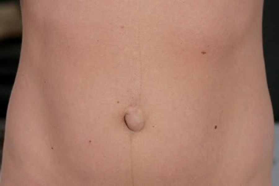 Pupochnaya-gryzha-u-podrostka