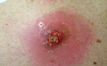 абсцесс после укола