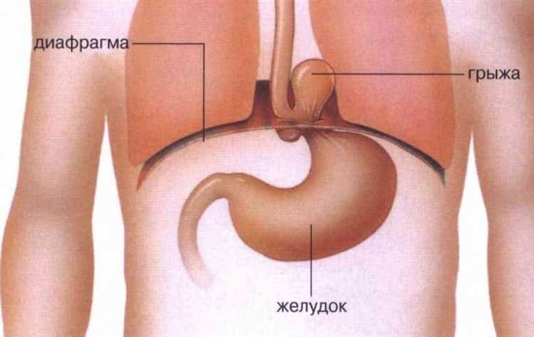 Как правильно диагностировать грыжу