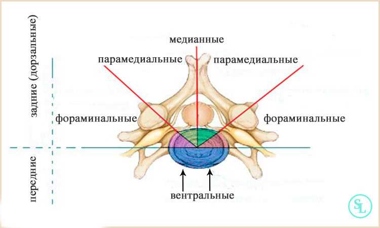 Альтернативные методы лечения грыжи и их эффективность