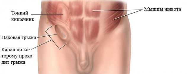 Опасности грыжи и серьезные осложнения на которые стоит обратить внимание