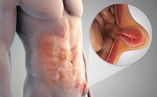 Как распознать и что делать при чревной грыже у детей