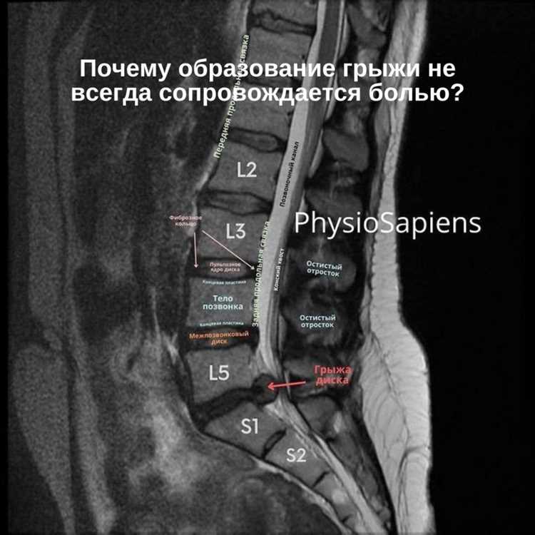 Грыжа причины возникновения и факторы риска