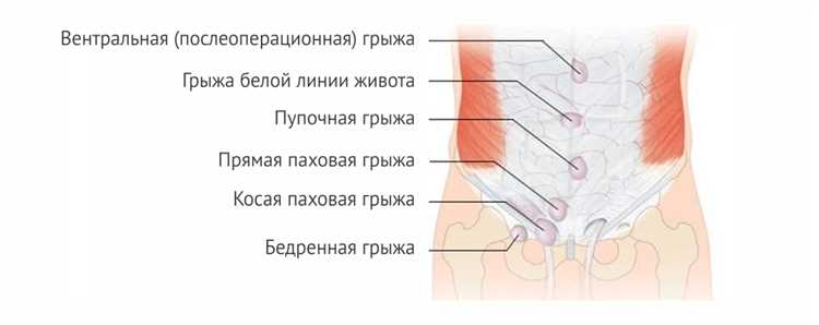 Грыжа основные причины и симптомы