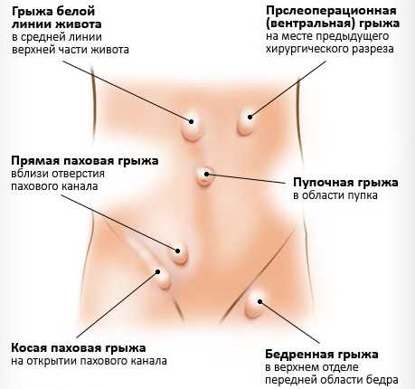 Полное руководство по грыже для новичков