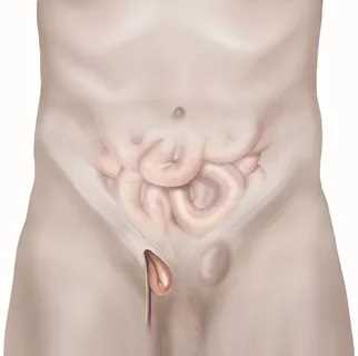 Факторы риска грыжи и способы минимизации угрозы для здоровья