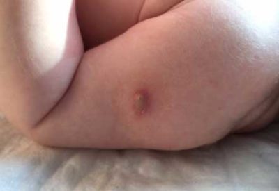 гноится место укола