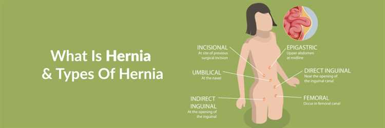 Грыжа при беременности риски и методы лечения