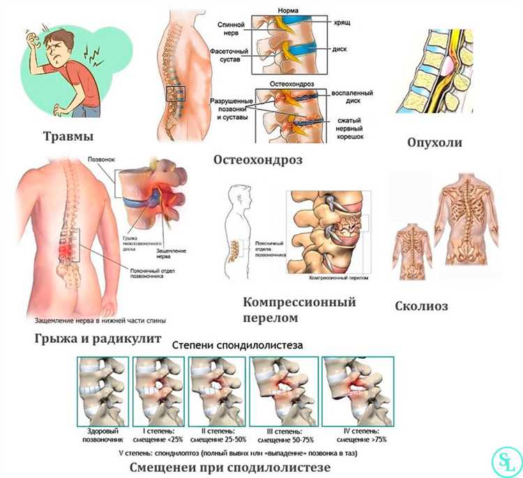 Грыжа при беременности риски и рекомендации для будущих мам