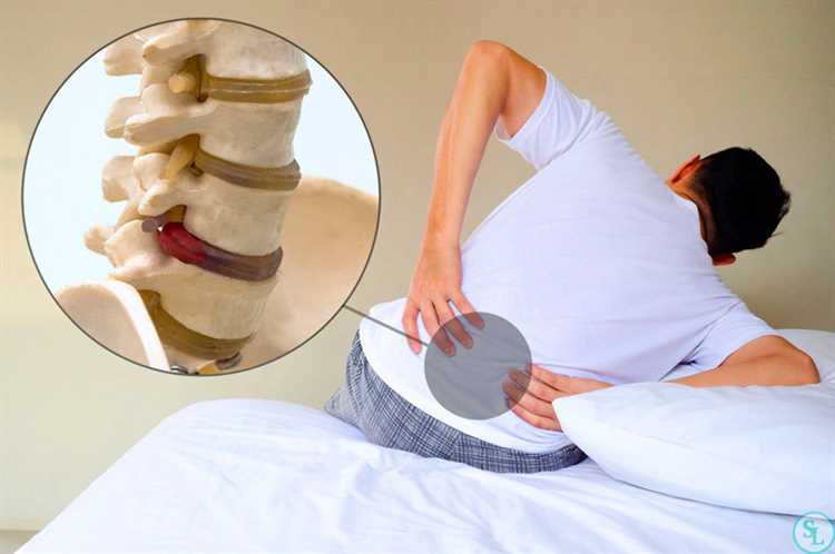 Эффективные домашние методы лечения грыжи от пациентов