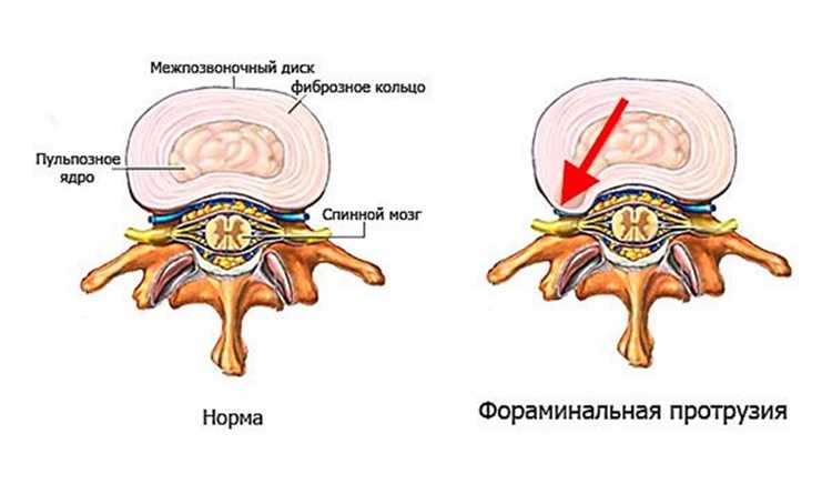 Грыжа и работа как сохранить здоровье на рабочем месте