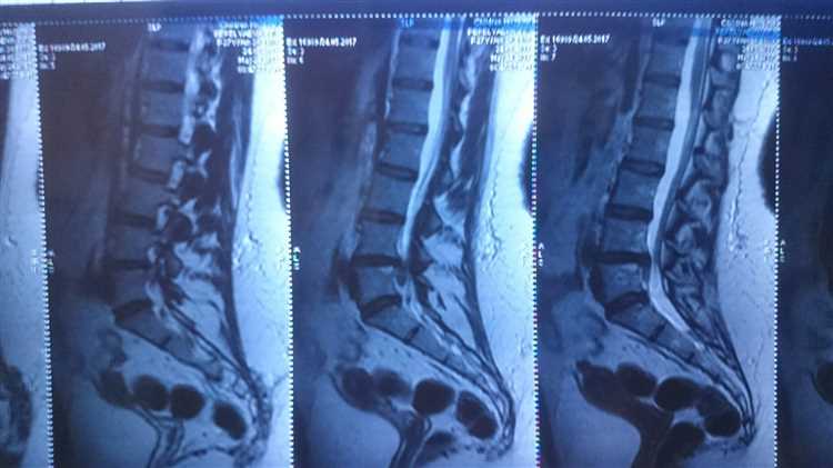 Грыжа и работа когда стоит увольняться а когда продолжать трудиться