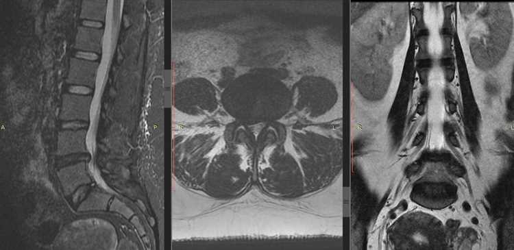 Грыжа и спорт как заниматься безопасно