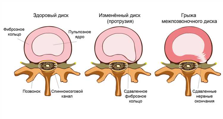 Влияние стресса на развитие грыжи и общее состояние здоровья