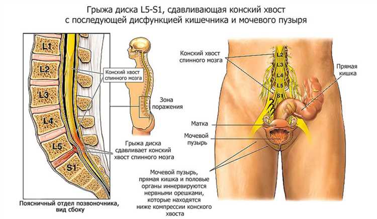Влияние физических упражнений на симптомы грыжи