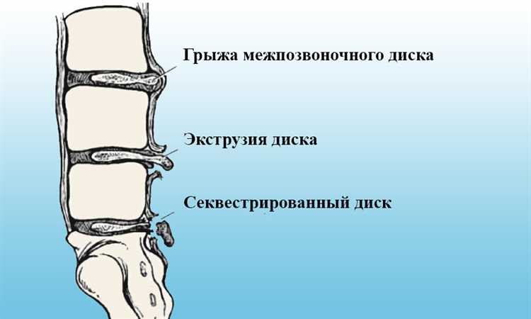 Истории пациентов о борьбе с грыжей и пути к выздоровлению