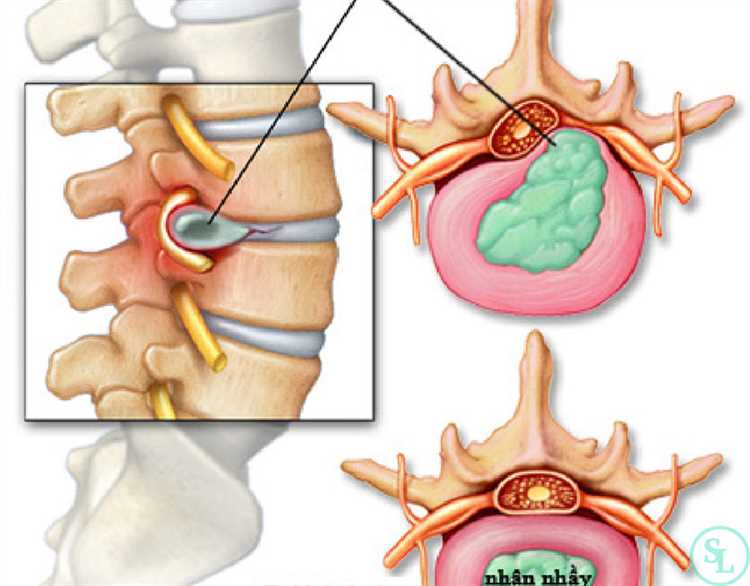 Быстрая и эффективная диагностика грыжи