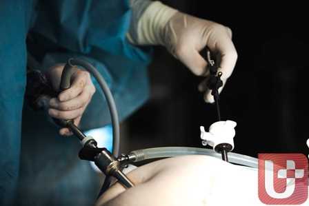 Новый подход к лечению грыжи с помощью лапароскопической операции