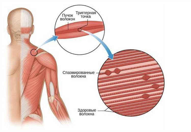 Как пациенты справляются с грыжей и находят облегчение своих симптомов