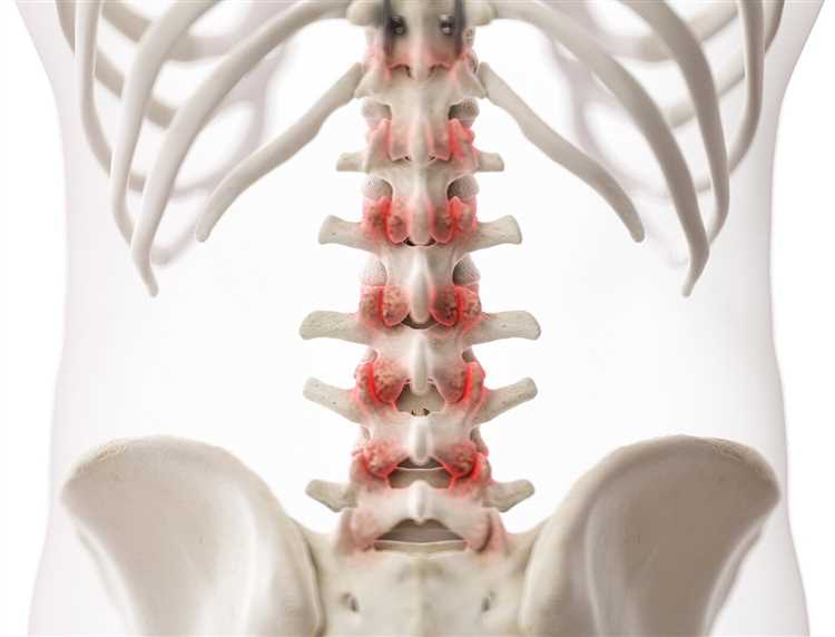 Как правильно диагностировать и эффективно лечить грыжу
