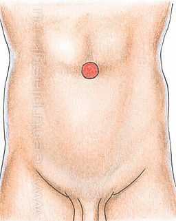 Как Распознать Симптомы Грыжи в Зависимости от Ее Типа