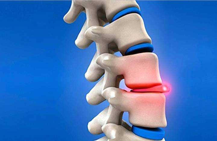 Как избежать хирургического вмешательства при грыже