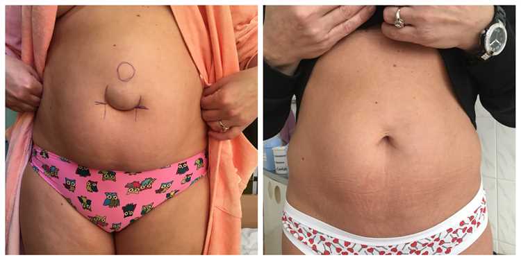 Как выбрать лучший метод лечения грыжи для вашего здоровья