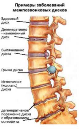 Как затянувшееся лечение грыжи влияет на здоровье