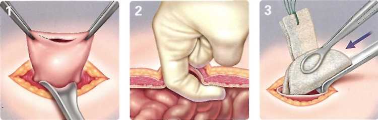 Грыжа и хирургическое вмешательство когда это становится необходимым
