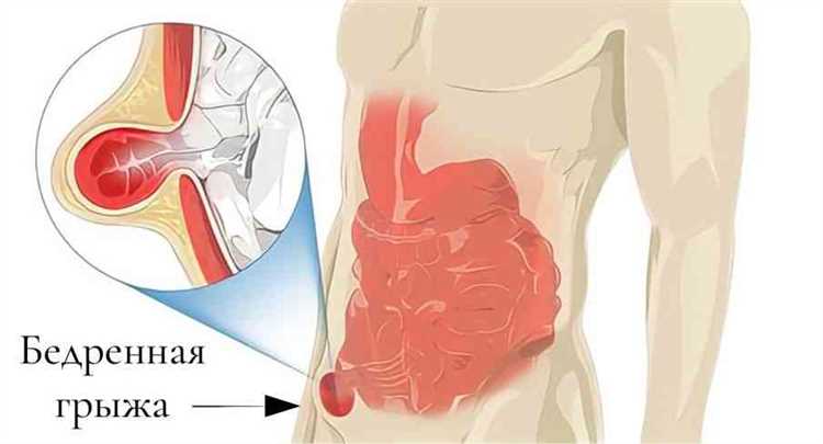 Истории пациентов о лечении и восстановлении после грыжи