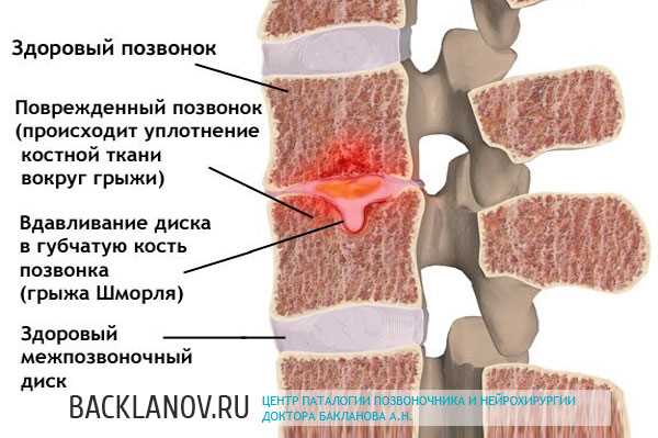 Грыжа причины симптомы и методы лечения