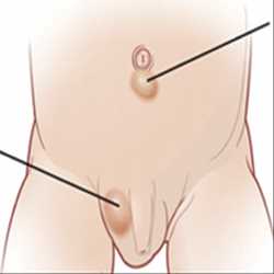Грыжа и её виды основные отличия заболеваний