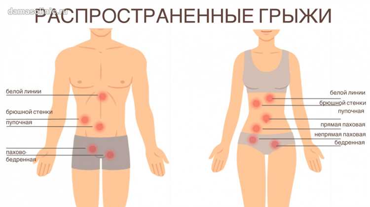 Грыжа пищевода как распознать и лечить