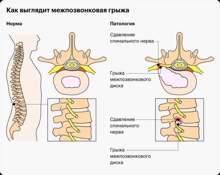 Грыжа позвоночника лечение и профилактика важных аспектов