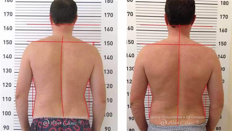 Грыжа позвоночника симптомы диагностика и современные способы лечения