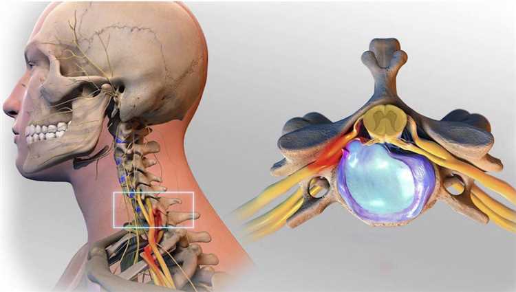 Грыжа причины возникновения и группа риска