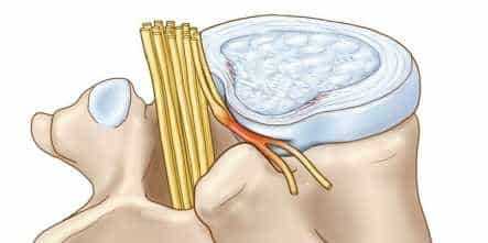 Грыжа причины возникновения и эффективные методы лечения