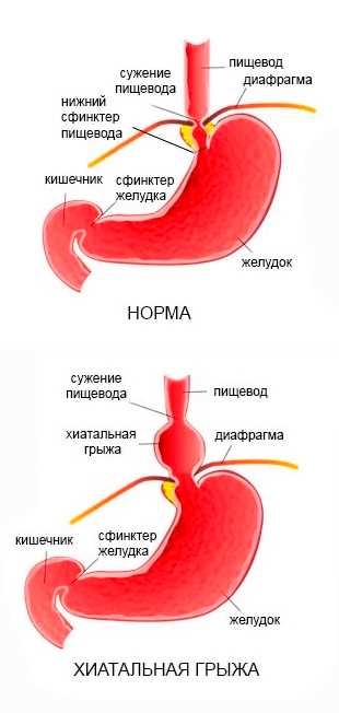 Грыжа симптомы диагностика и эффективные методы лечения