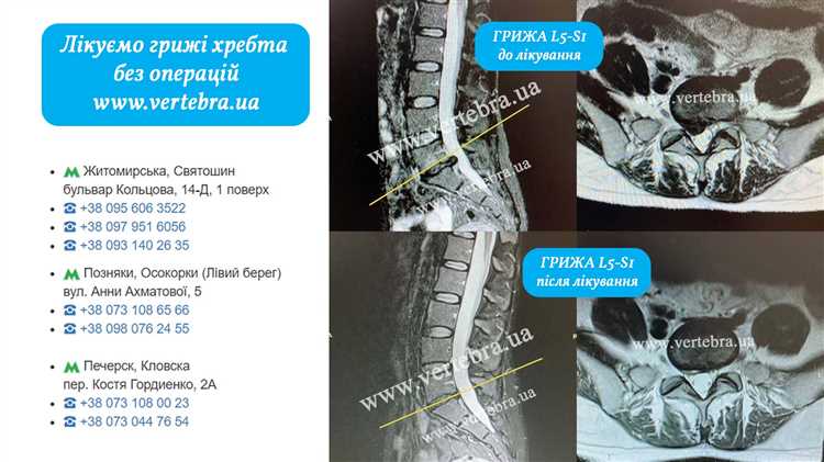 Грыжа симптомы диагностика и современные способы лечения