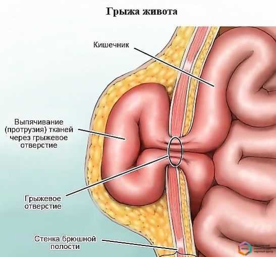 Современные подходы к обследованию и диагностике грыжи