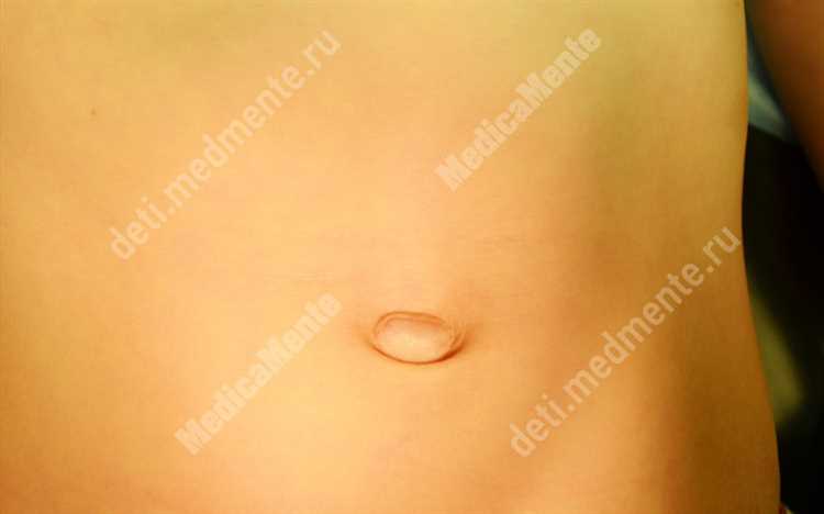 Грыжа и операции что нужно знать прежде чем принять решение